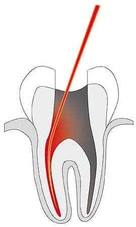 Bild Endodontie / © Cumdente